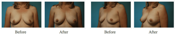 Fat Transfer to Breast Before and After Pictures Salt Lake City, UT