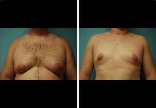 Gynecomastia Before and After Pictures Salt Lake City, UT