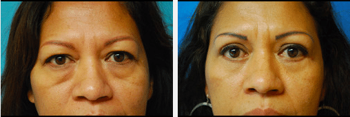 Blepharoplasty Before and After Pictures Salt Lake City, UT