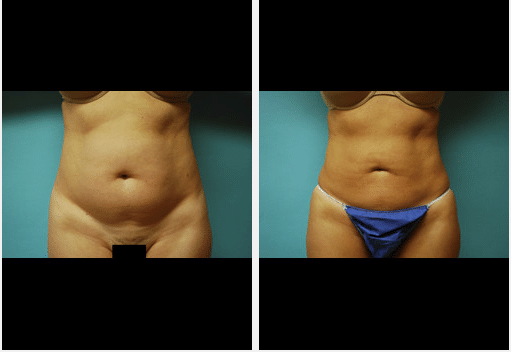 Liposuction Before and After Pictures Salt Lake City, UT