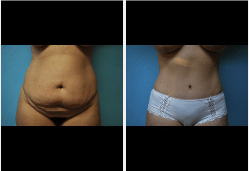 Tummy Tuck Before and After Pictures Salt Lake City, UT