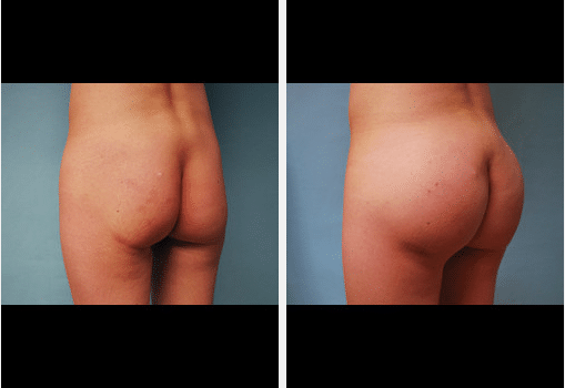 Brazilian Butt Lift Before and After Pictures Salt Lake City, UT