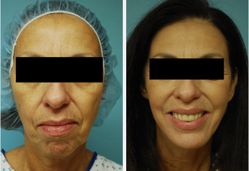 Chin Implant Surgery Before and After Pictures Salt Lake City, UT
