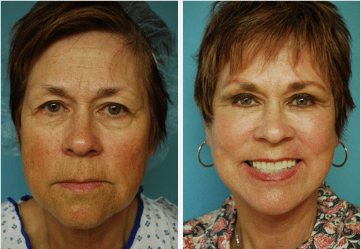 Facelift Before and After Pictures Salt Lake City, UT
