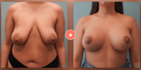 Breast Augmentation Before and After Pictures Bucks County, PA and Hunterdon County, NJ