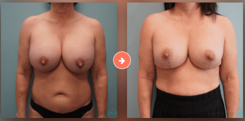 Breast Augmentation Before and After Pictures Bucks County, PA and Hunterdon County, NJ