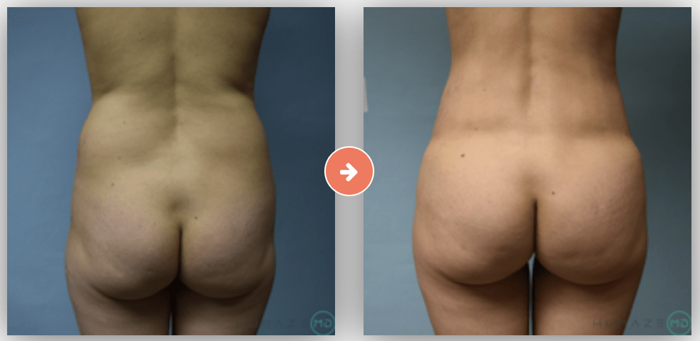 Breast Augmentation Before and After Pictures Bucks County, PA and Hunterdon County, NJ