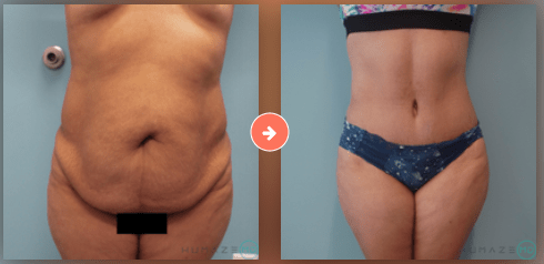 Lipo1
