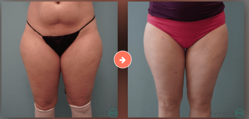 Lipo2