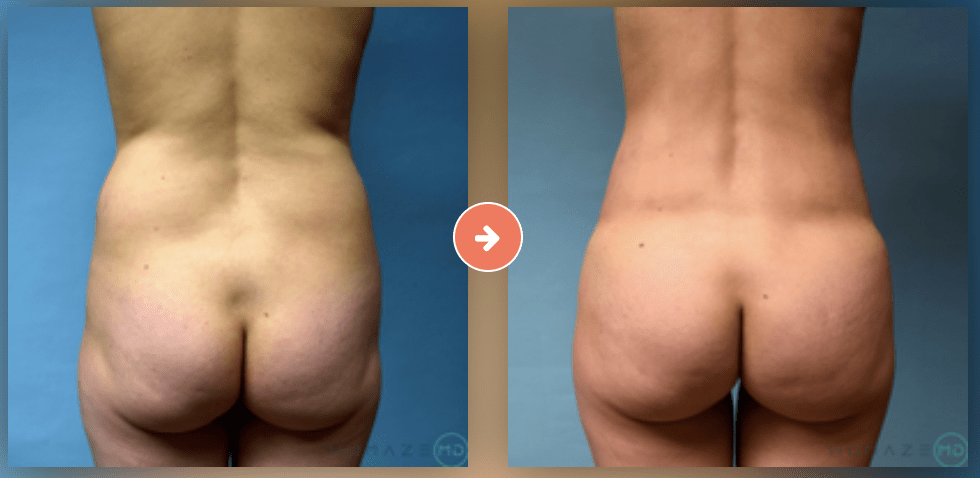 Before and After Butt Lift Murray UT