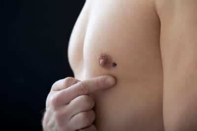 gynecomastia1