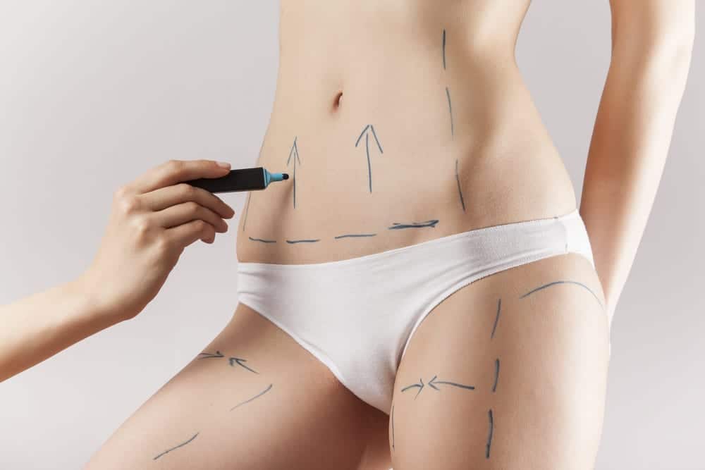 liposuction 2
