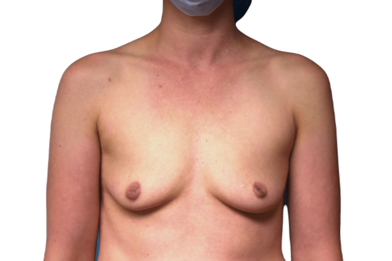 Before Image: Breast Augmentation - front