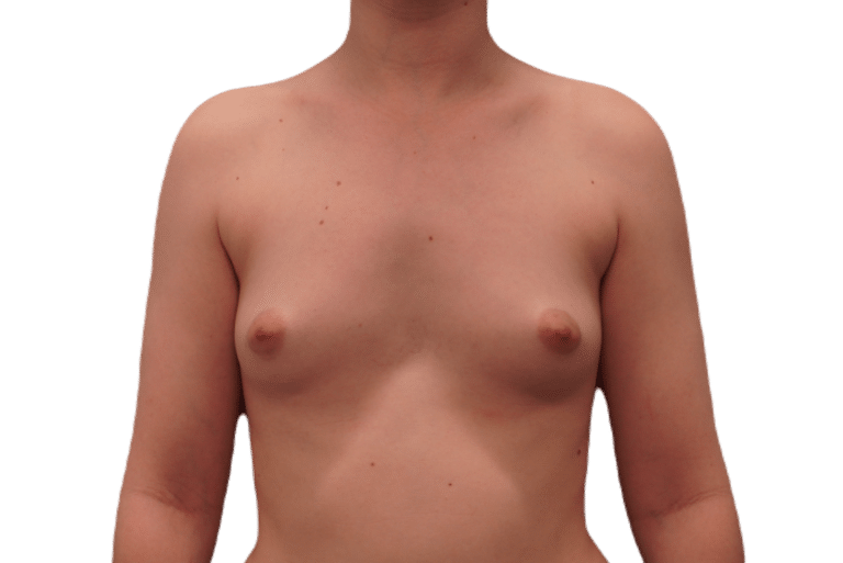 Before Image: Breast Augmentation - front