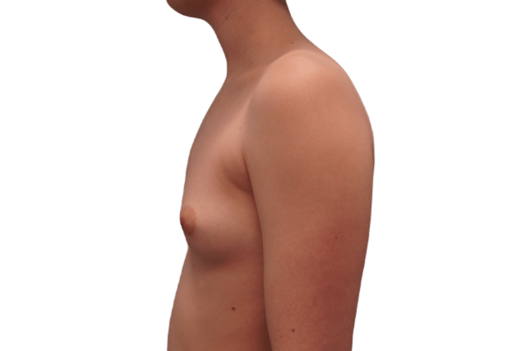 Before Image: Breast Augmentation - left-side