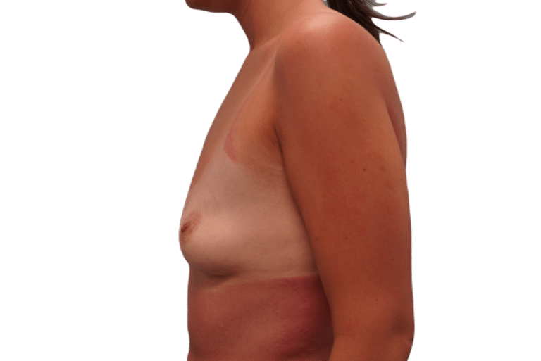 Before Image: Breast Augmentation - left-side
