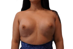 After Image: Breast Augmentation