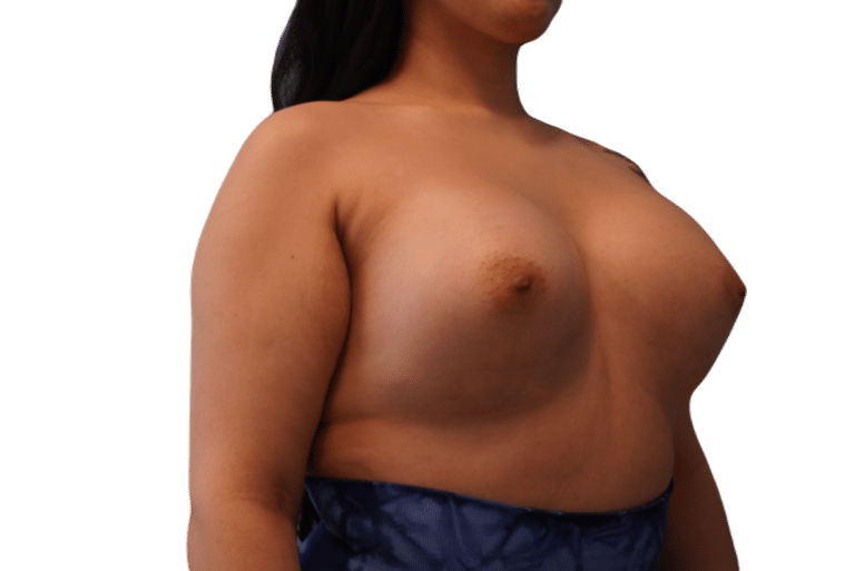 After Image: Breast Augmentation - right-front-oblique