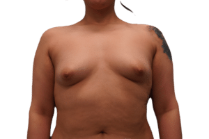 Before Image: Breast Augmentation