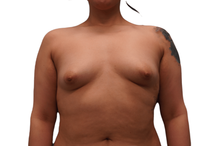 Before Image: Breast Augmentation - front