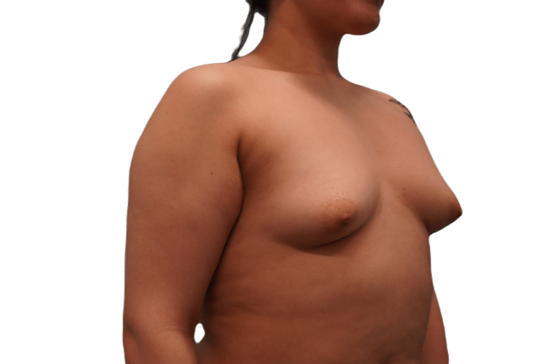 Before Image: Breast Augmentation - right-front-oblique