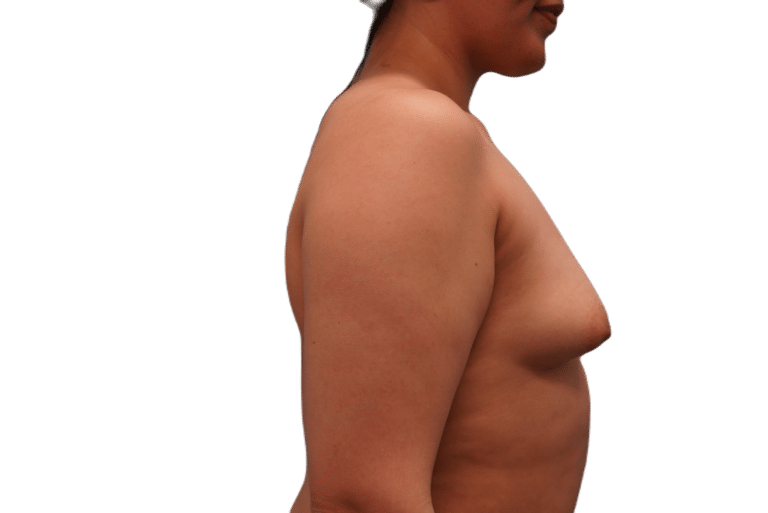 Before Image: Breast Augmentation - right-side