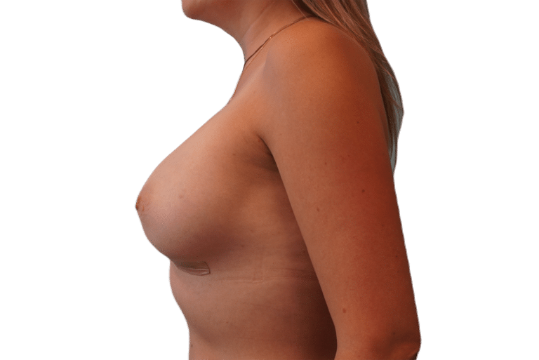 After Image: Breast Augmentation - left-side