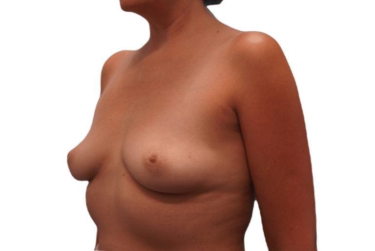 Before Image: Breast Augmentation - left-front-oblique