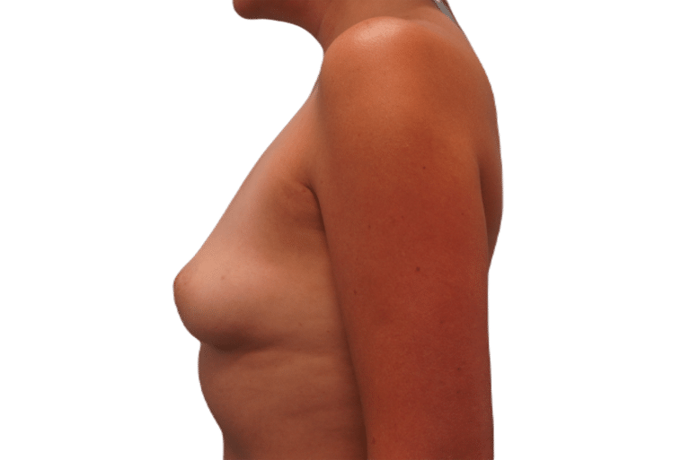 Before Image: Breast Augmentation - left-side