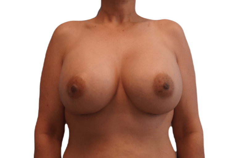 After Image: Breast Augmentation - front