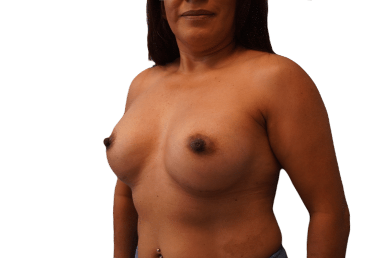 After Image: Breast Augmentation - left-front-oblique