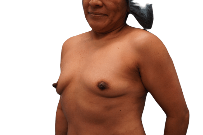 Before Image: Breast Augmentation - left-front-oblique