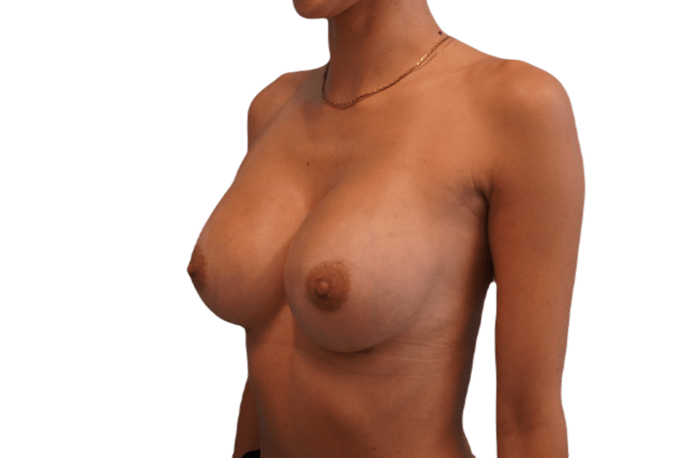 After Image: Breast Augmentation - left-front-oblique