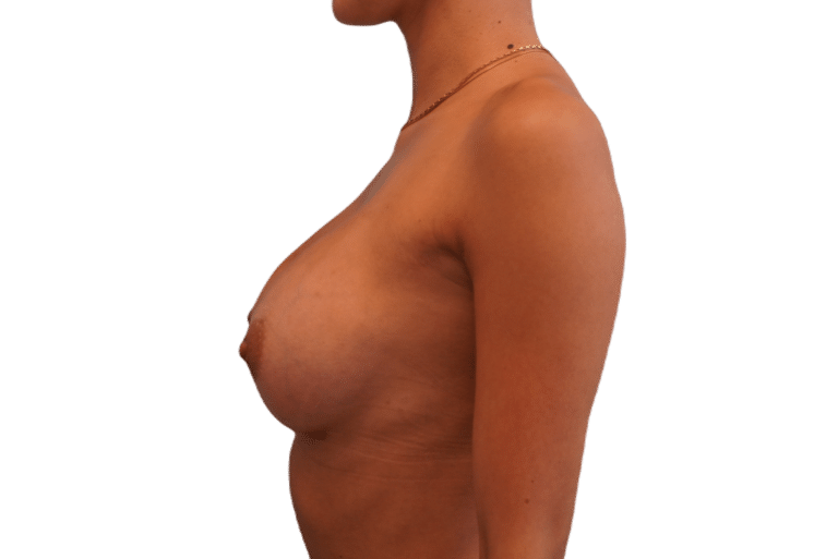 After Image: Breast Augmentation - left-side