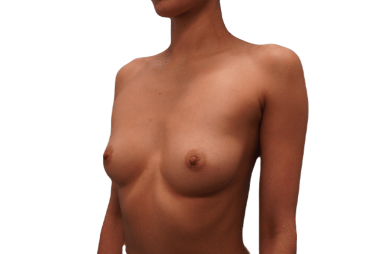 Before Image: Breast Augmentation - left-front-oblique