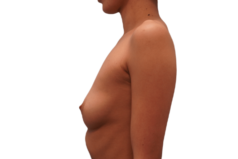 Before Image: Breast Augmentation - left-side