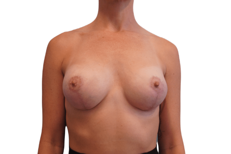 After Image: Breast Augmentation and Lift - front