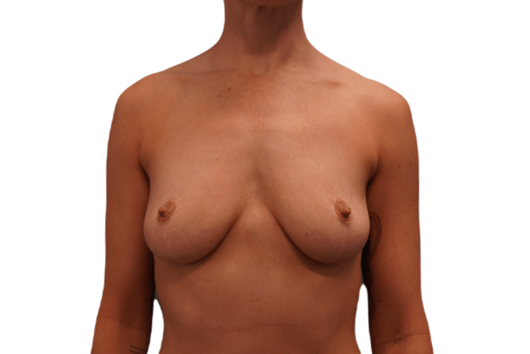Before Image: Breast Augmentation and Lift - front