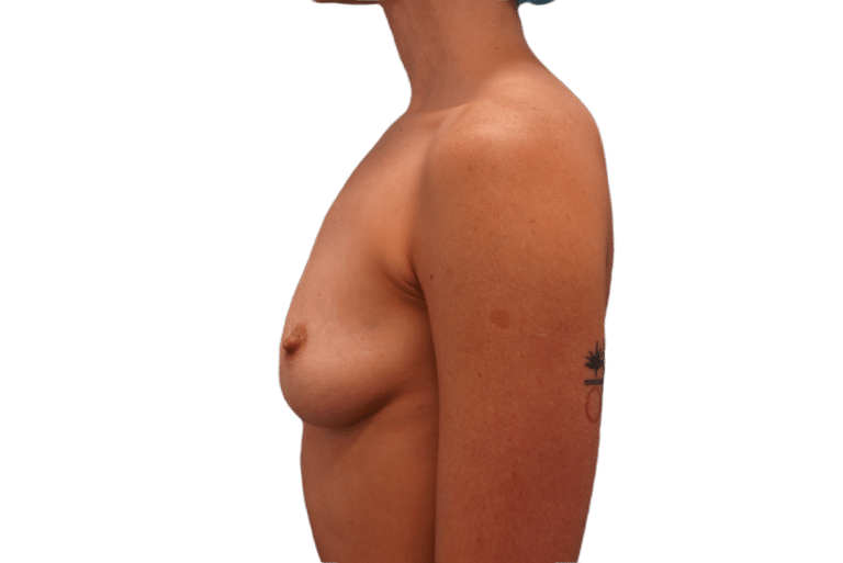 Before Image: Breast Augmentation and Lift - left-side