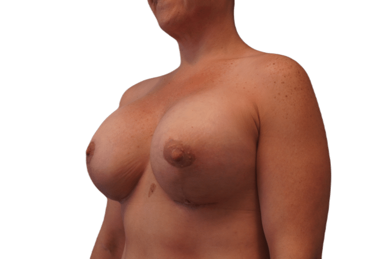 After Image: Breast Augmentation and Lift - left-front-oblique