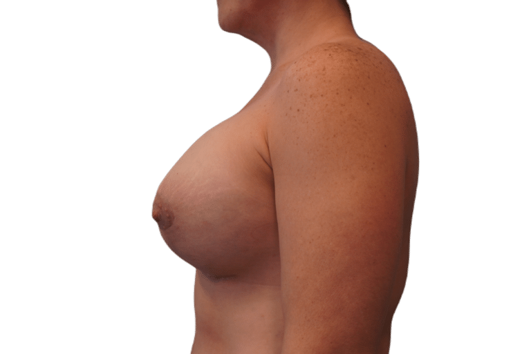 After Image: Breast Augmentation and Lift - left-side
