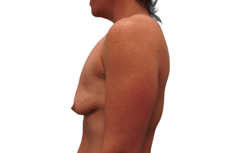 Before Image: Breast Augmentation and Lift - left-side