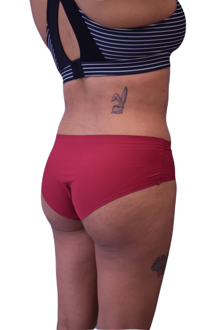 After Image: Brazilian Butt Lift - right-back-oblique