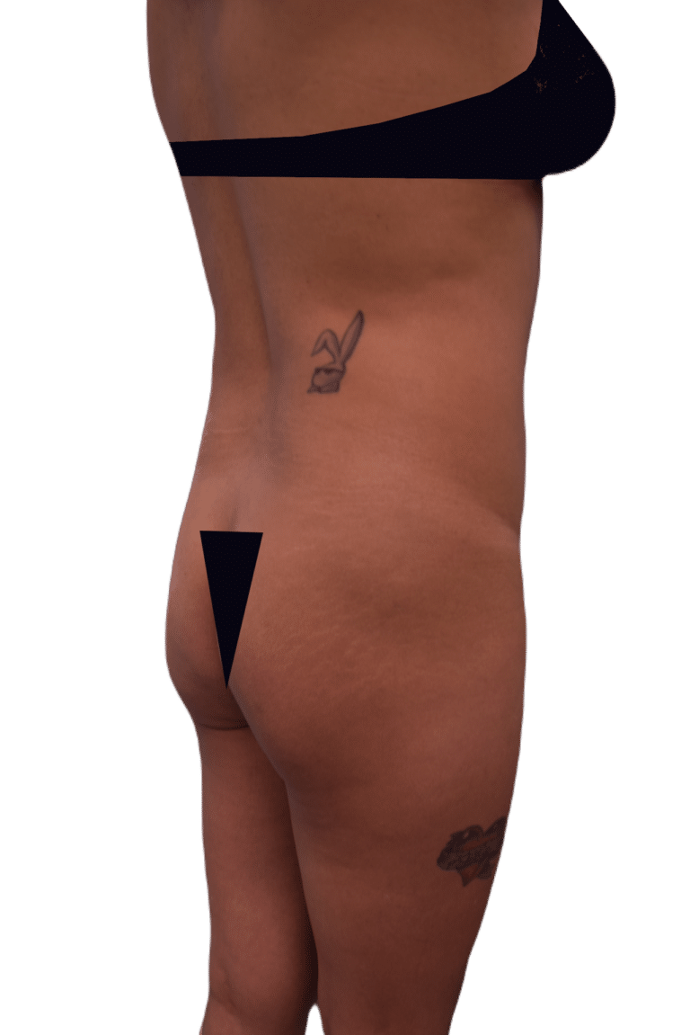 Before Image: Brazilian Butt Lift - right-back-oblique