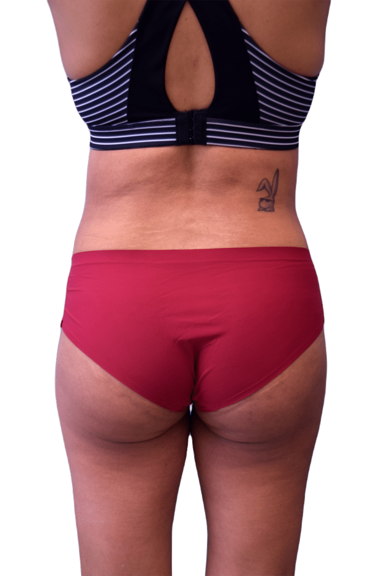 After Image: Brazilian Butt Lift - back