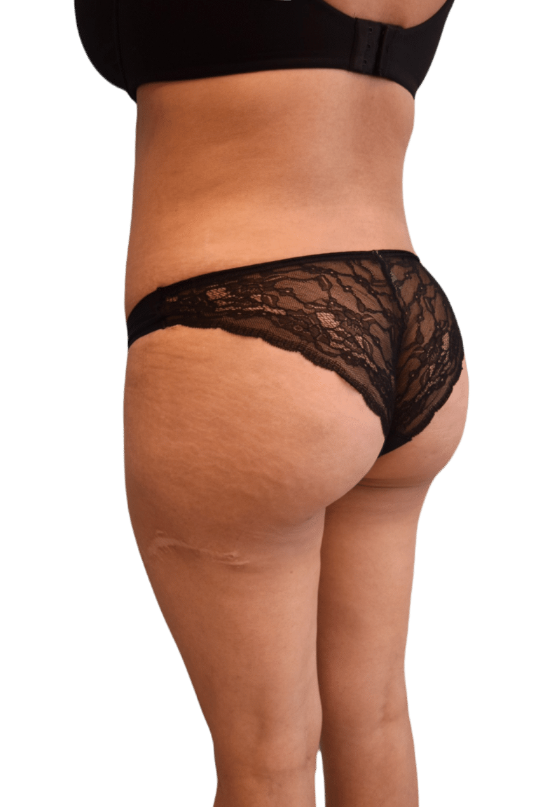 After Image: Brazilian Butt Lift - left-back-oblique