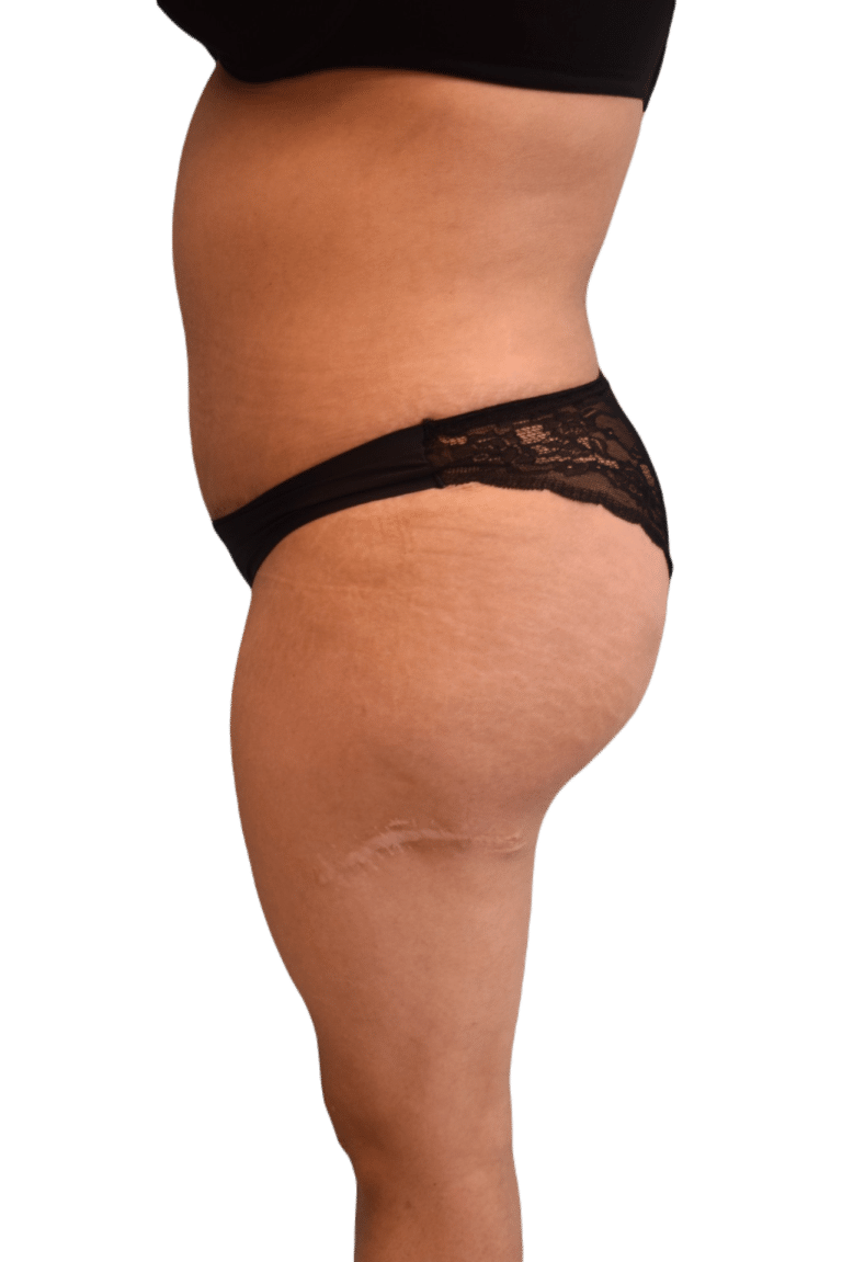 After Image: Brazilian Butt Lift - left-side