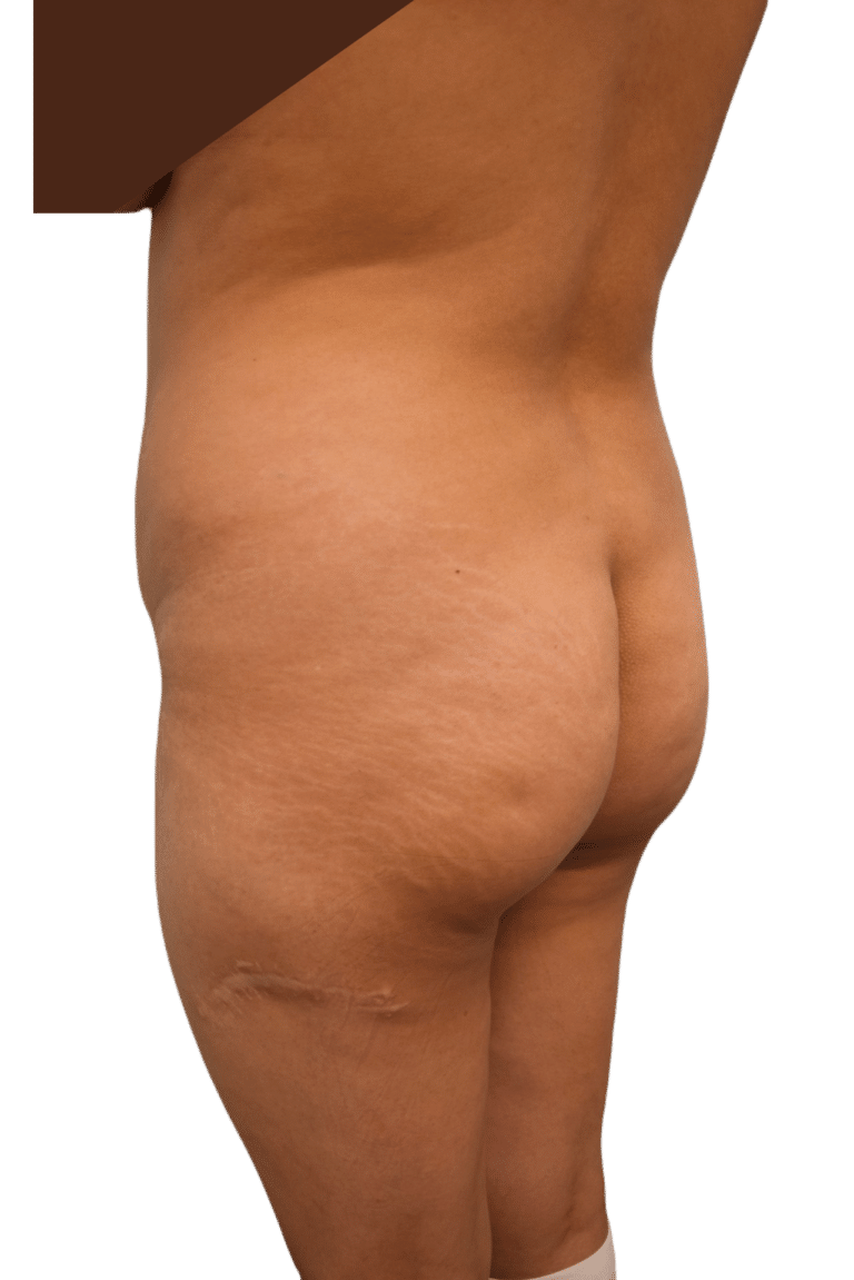 Before Image: Brazilian Butt Lift - left-back-oblique
