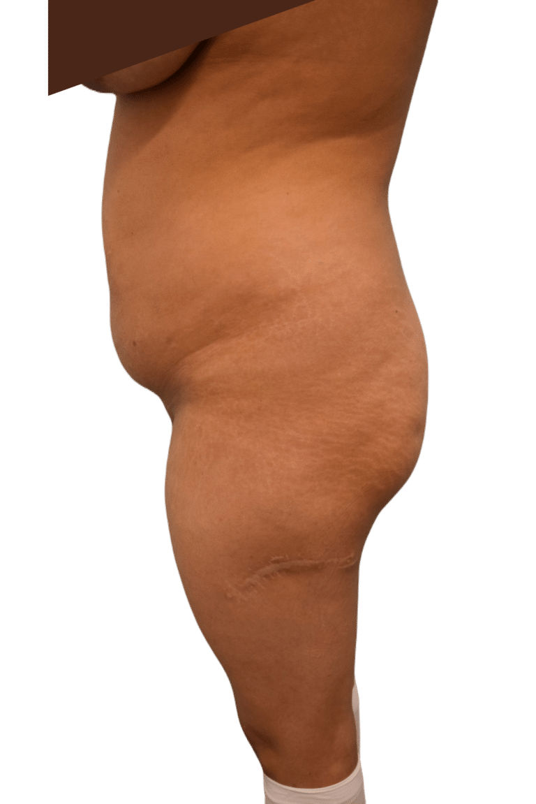 Before Image: Brazilian Butt Lift - left-side