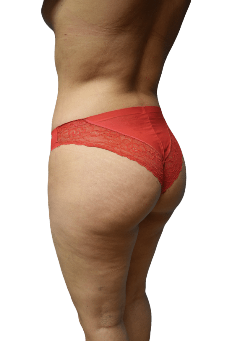 After Image: Brazilian Butt Lift - left-back-oblique